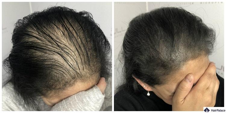 Haar Tattoo vorher und nacher Frauen